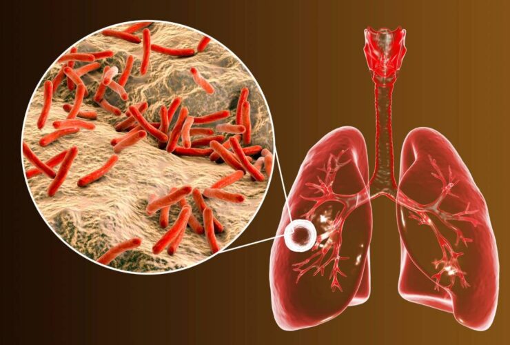 علائم سل چیست؟ راه های تشخیص و پیشگیری از