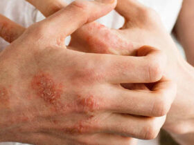 علت و درمان اورژانسی خارش شدید پوست چیست؟
