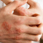 روش های درمان خارش پوست ناشی از نیش حشرات