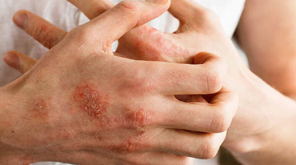 روش های درمان خارش پوست ناشی از نیش حشرات