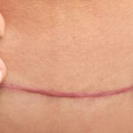 hypertrophic vs keloid scars fp 2000x1000 1