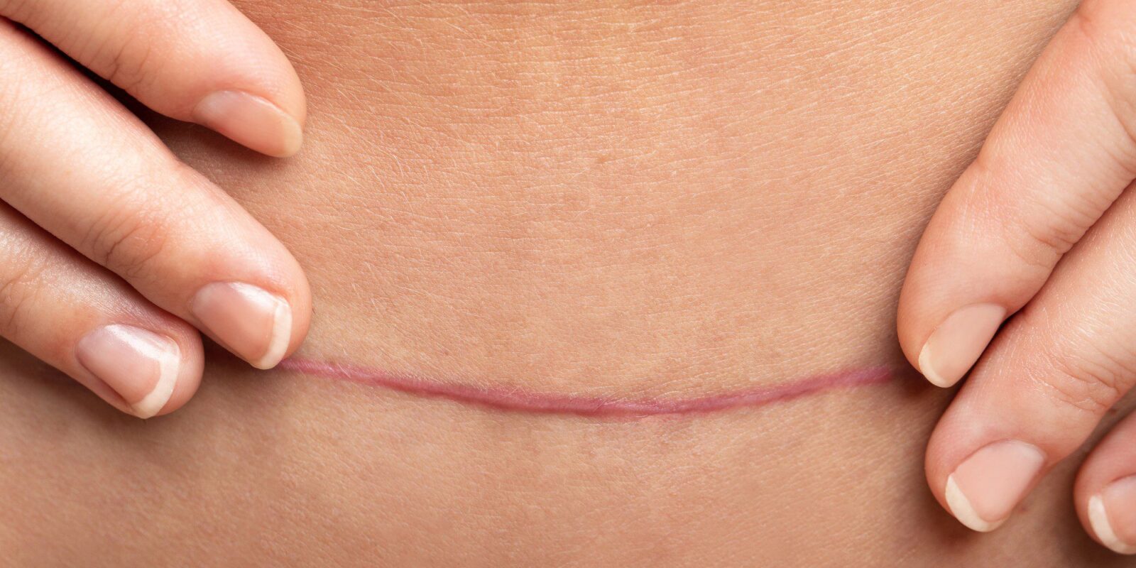 hypertrophic vs keloid scars fp 2000x1000 1