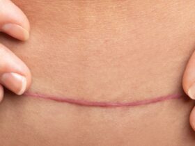 hypertrophic vs keloid scars fp 2000x1000 1