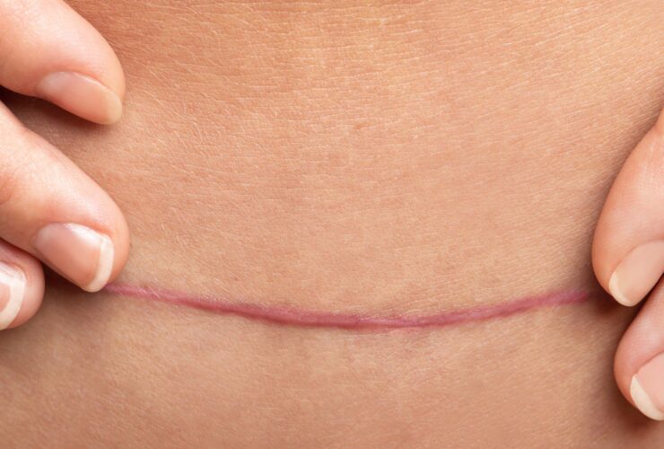 hypertrophic vs keloid scars fp 2000x1000 1