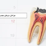 root canal treatment min