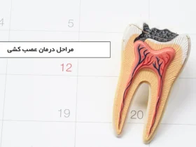 root canal treatment min