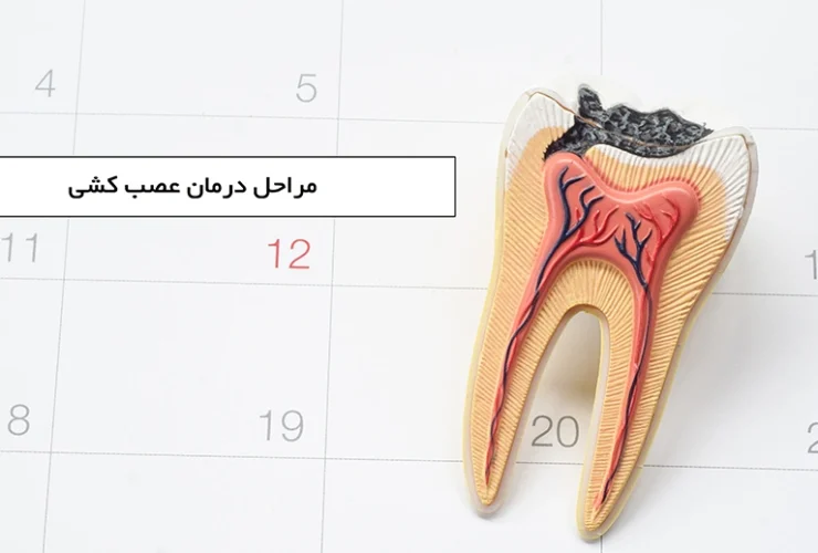 root canal treatment min