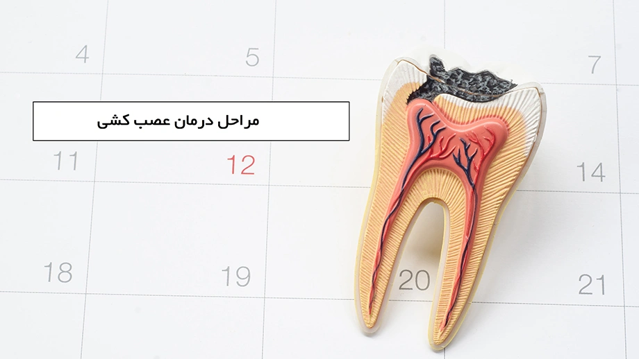 root canal treatment min