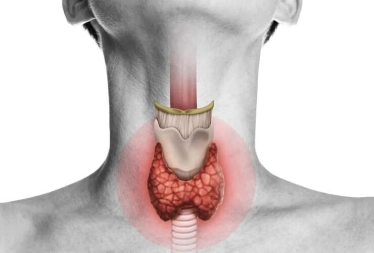 آیا درمان گیاهی قطعی برای بیماری تیروئید وجود دارد؟