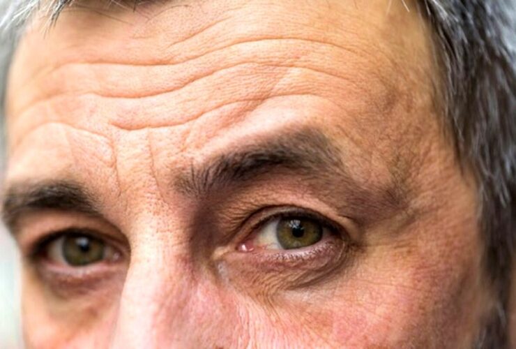 راهی برای درمان و کاهش چین و چروک صورت