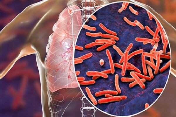 سل همچنان یکی از کشنده ترین بیماری های عفونی در