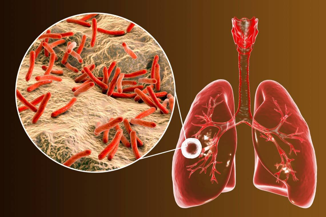 سل چیست و چه علائمی دارد؟ بهترین زمان برای