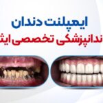 ایمپلنت، ارتودنسی و کامپوزیت دندان