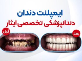 ایمپلنت، ارتودنسی و کامپوزیت دندان