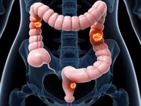 بهترین داروی گیاهی برای پیشگیری از سرطان روده بزرگ