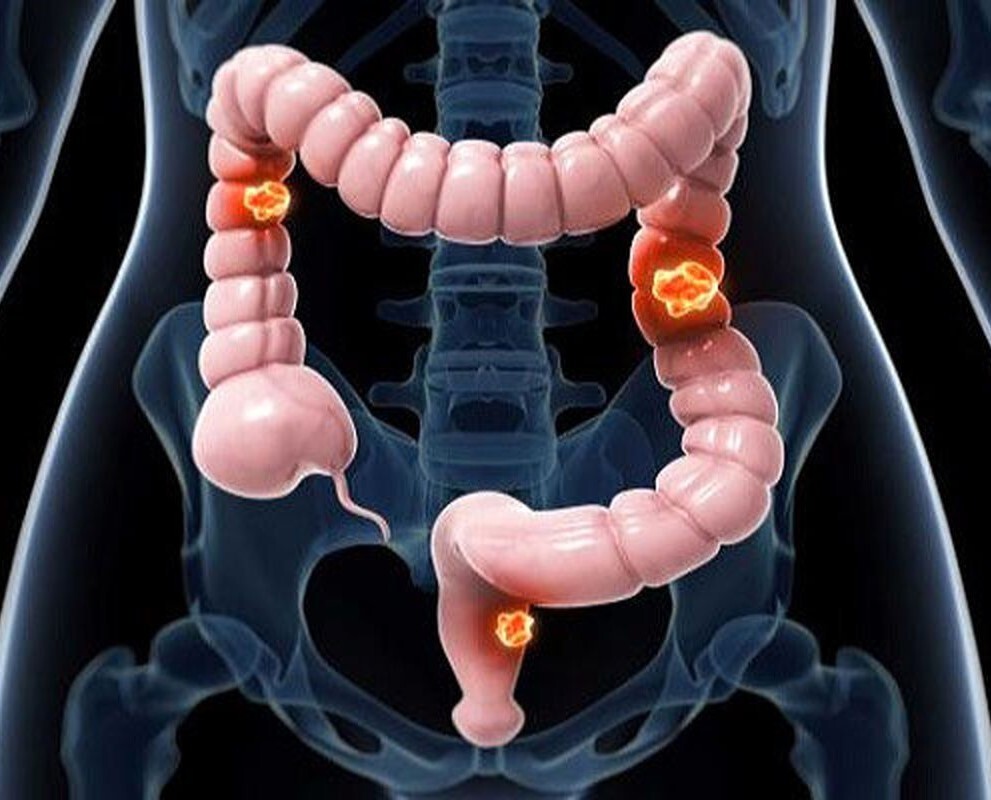 بهترین داروی گیاهی برای پیشگیری از سرطان روده بزرگ