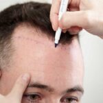 A variety of hair transplant methods