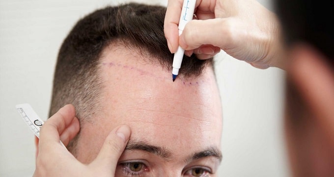 A variety of hair transplant methods