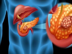 کمردرد یکی از علائم اولیه سرطان پانکراس است