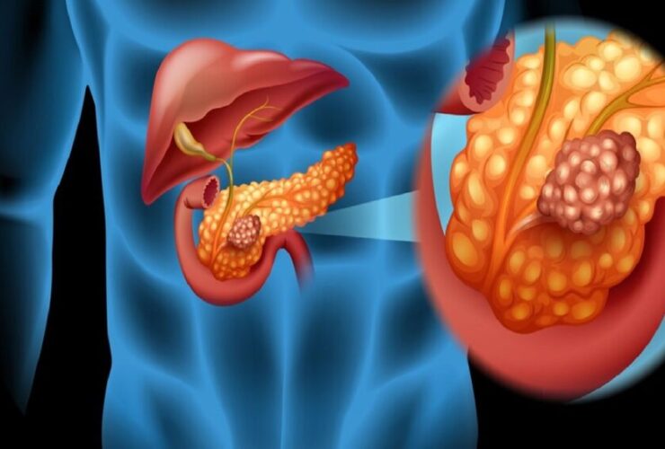 کمردرد یکی از علائم اولیه سرطان پانکراس است 17 کمردرد یکی از علائم اولیه سرطان پانکراس است