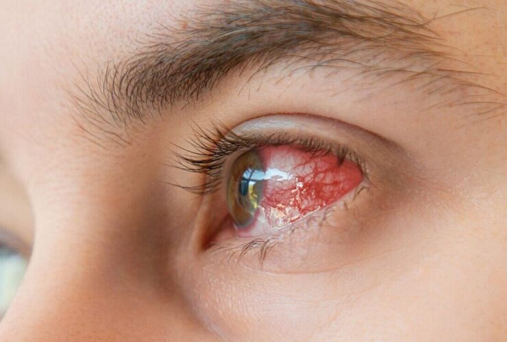 این بیماری بینایی را کاهش می دهد