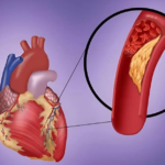 برای جلوگیری از سکته مغزی خون دهید