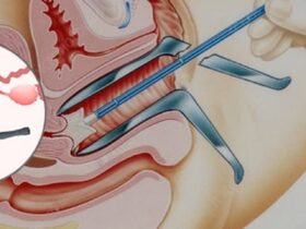 تغییرات در پوشش دهانه رحم علل، علائم و درمان