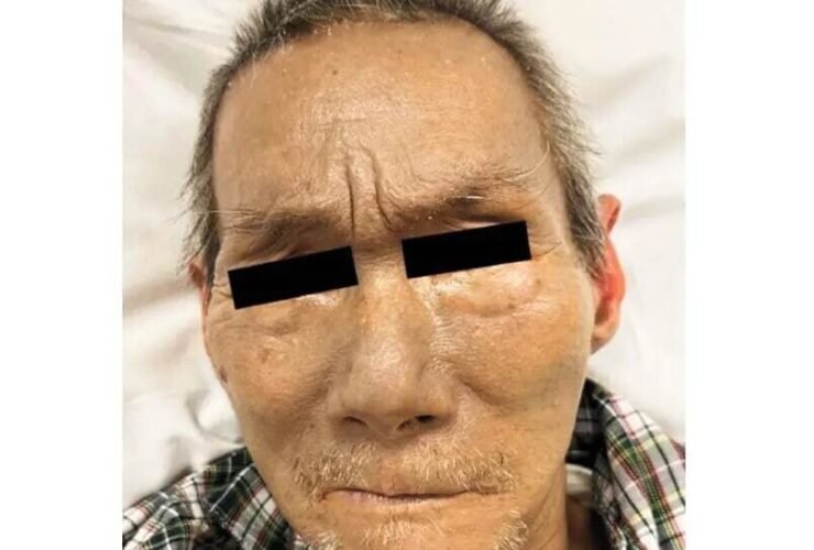 راز عجیب مردی که پوستش خاکستری شد