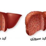 سیروز کبدی؛ قاتل خاموش سلامتی