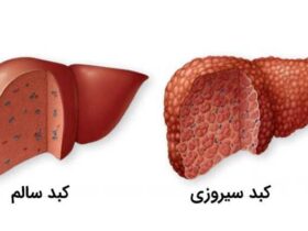 سیروز کبدی؛ قاتل خاموش سلامتی