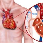 موثرترین روش برای درمان سکته قلبی چیست؟