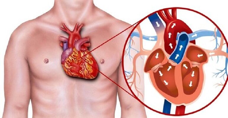 موثرترین روش برای درمان سکته قلبی چیست؟