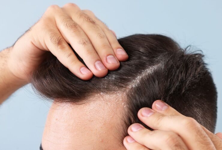 بهترین راه برای درمان سبوس در خانه