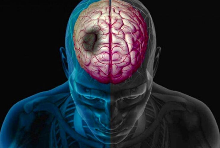 کاهش خطر سکته مغزی با فعالیت بدنی منظم در بیمه درمانی / پیروی از سیاست های بهداشتی