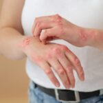 یک دلیل مهم برای اگزما روی پوست