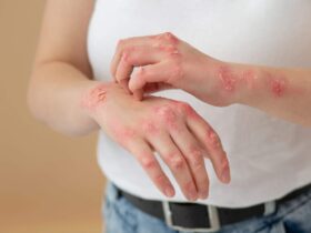 یک دلیل مهم برای اگزما روی پوست
