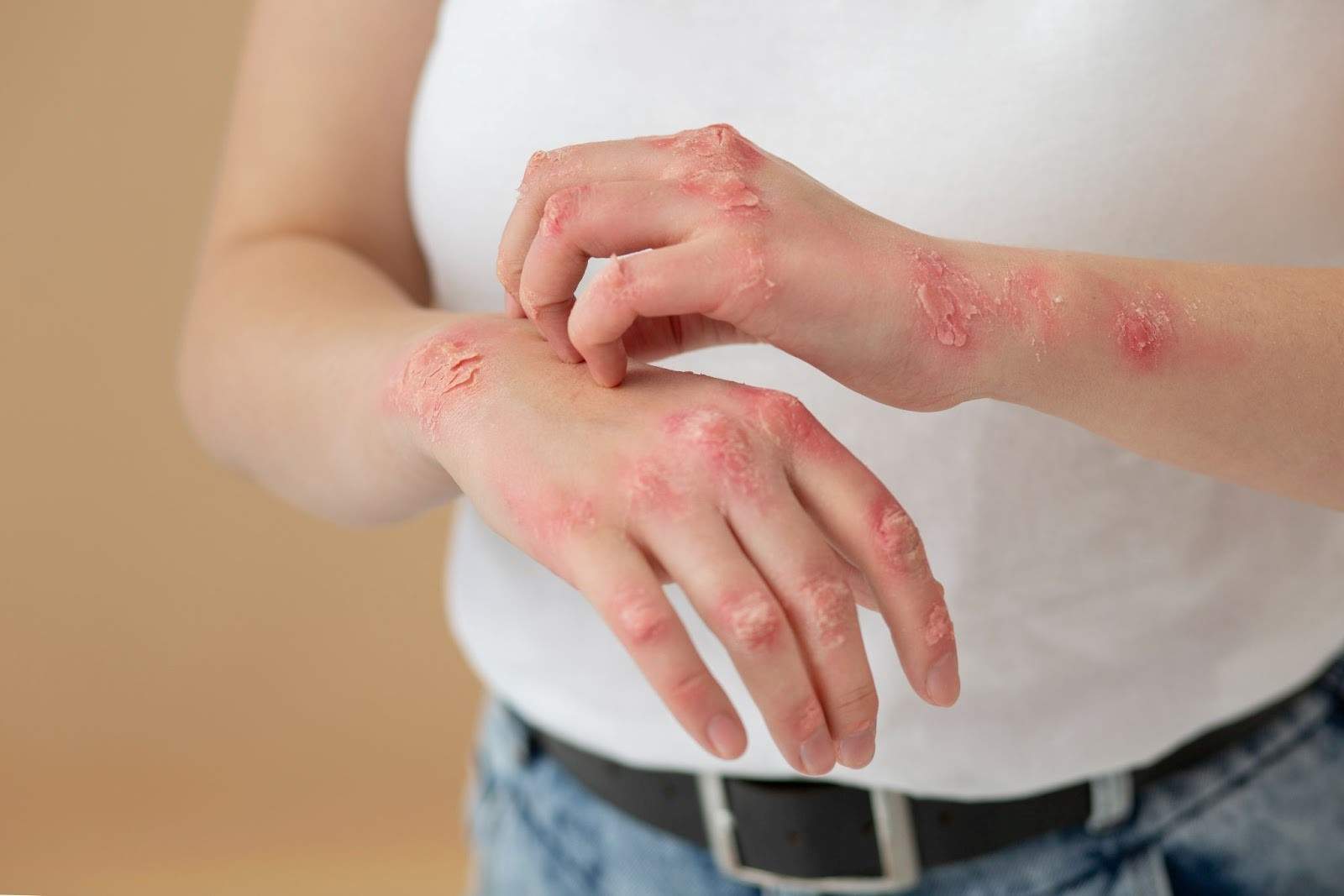 یک دلیل مهم برای اگزما روی پوست