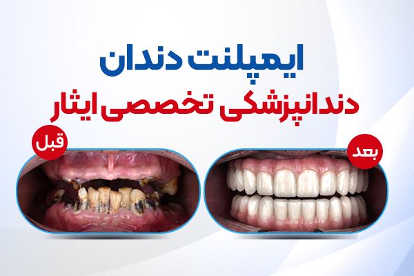 ایمپلنت و ارتودنسی و کامپوزیت دندانپزشکی