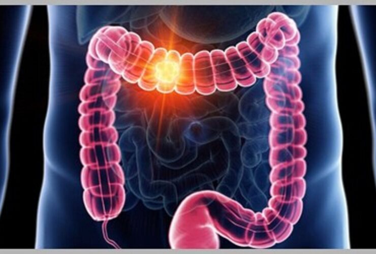 علائم اولیه سرطان روده بزرگ چیست؟