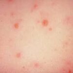 بیماری بهاری Chicisepox؟