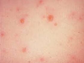 بیماری بهاری Chicisepox؟