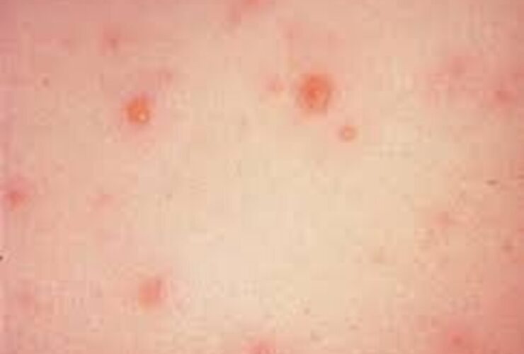 بیماری بهاری Chicisepox؟