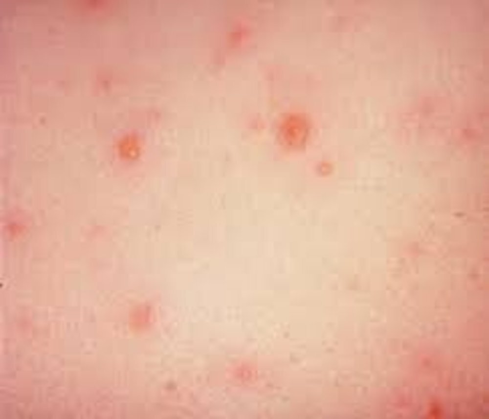 بیماری بهاری Chicisepox؟