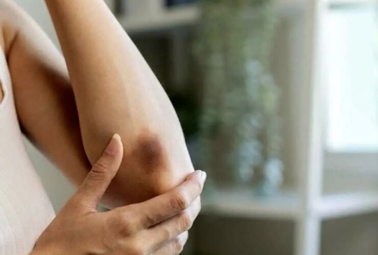 اختلال نادر در پشت کبودی های شما پنهان شده است