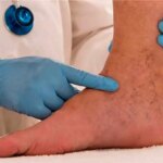 علائم اولیه رگهای واریس