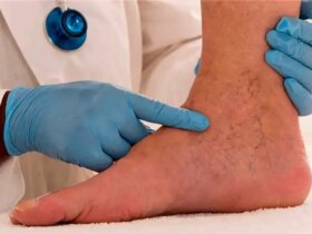 علائم اولیه رگهای واریس