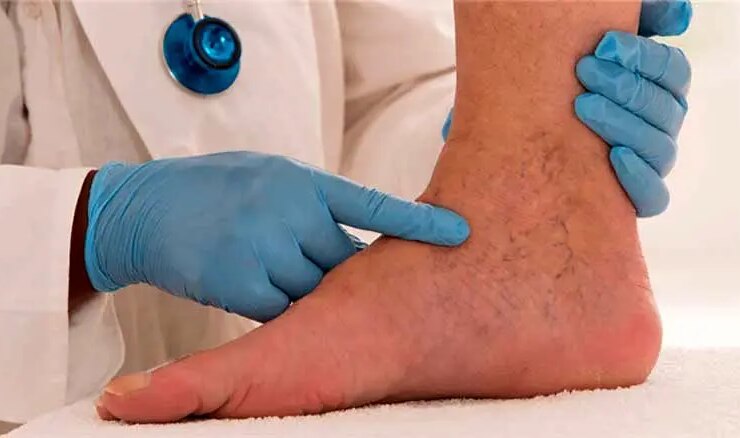 علائم اولیه رگهای واریس