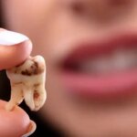 چرا دندان ها زود پوسیده می شوند؟