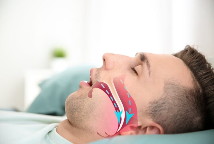 آپنه خواب ؛ یک تهدید ساکت برای نفس کشیدن