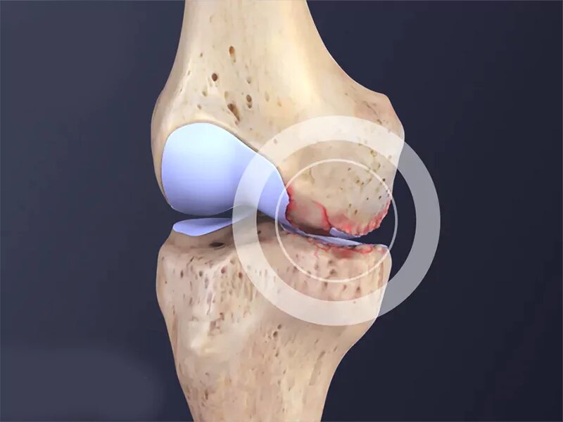 آرتریت زانو ؛ از پیر شدن تا تأثیر سبک زندگی